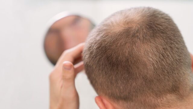 Micropigmentación capilar La solución al injerto capilar